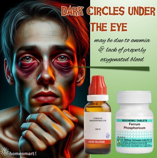 Dark Circles Caused by Anemia Treatment and Prevention Tips